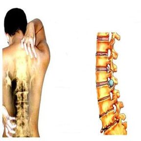 Etapy osteochondrosy