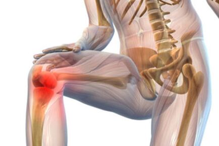 Bolest v kolenním kloubu s artrózou