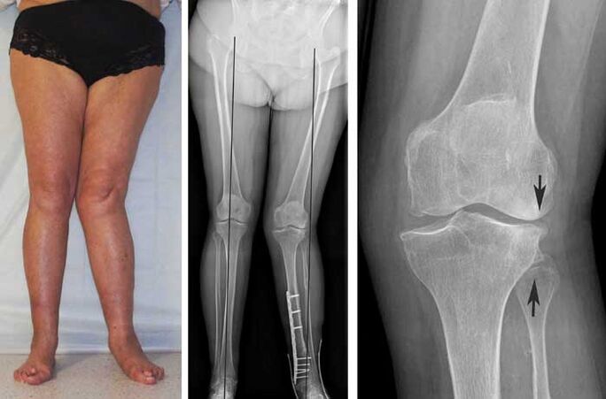pokročilá artróza kolenního kloubu