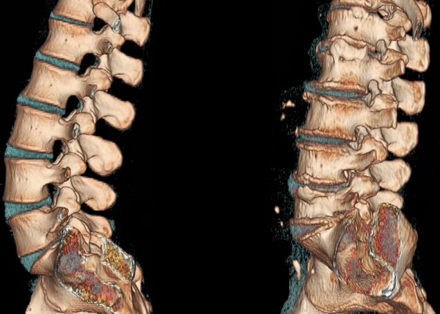 Osteochondróza páteře na CT vyšetření