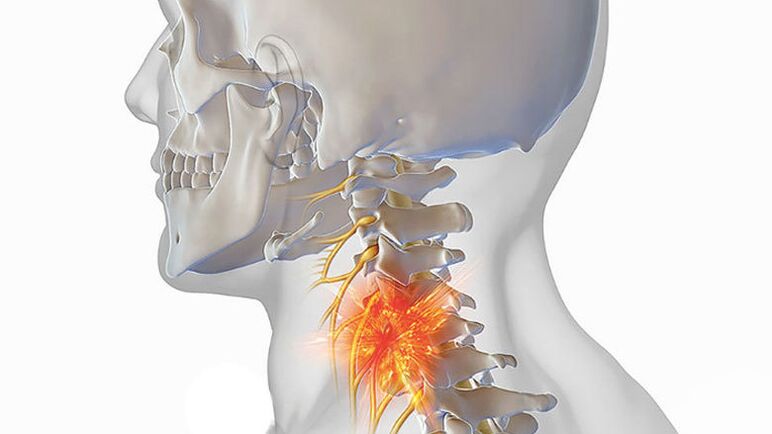 zdroj bolesti při cervikální osteochondróze